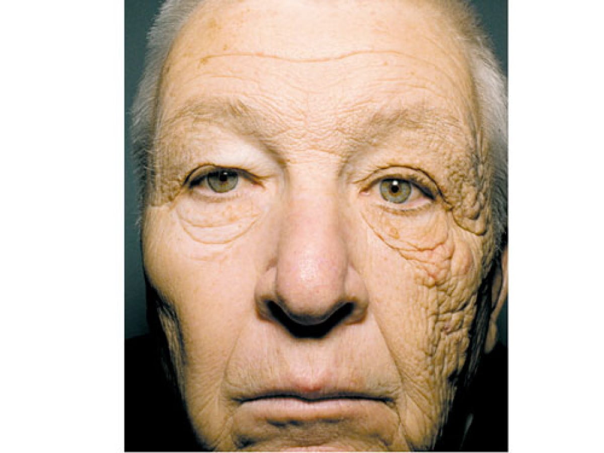 Gương mặt của người đàn ông này đã bị lão hóa nặng và chảy xệ 1 bên chỉ vì nắng.