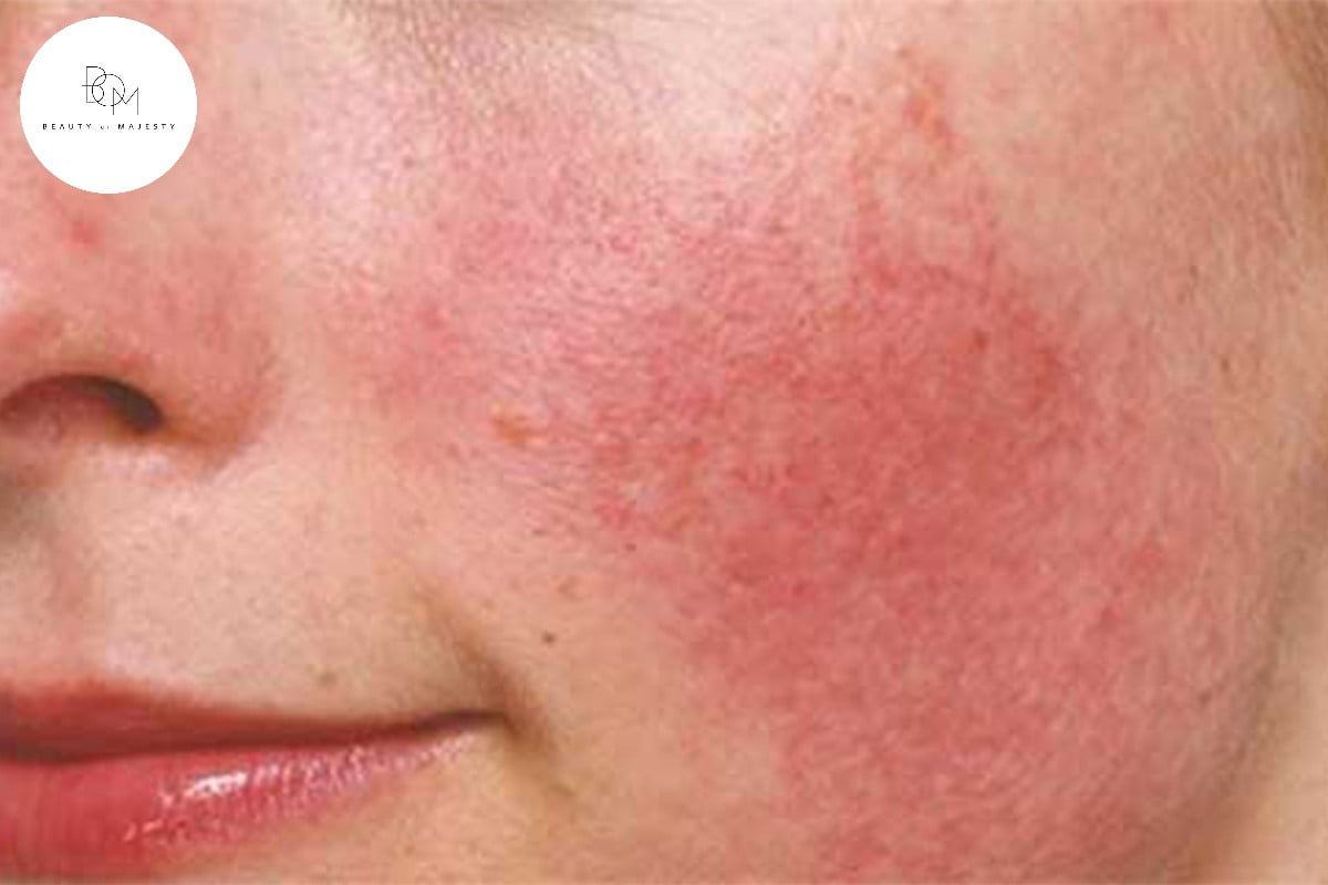 Đối với làn da dễ bị kích ứng, mẩn đỏ hay cháy nắng sau khi đi ra ngoài thì cần sử dụng loại mặt nạ giúp làm dịu làn da. Lô hội, nghệ, bột yến mạch và nhất là mật ong kết hợp với vitamin